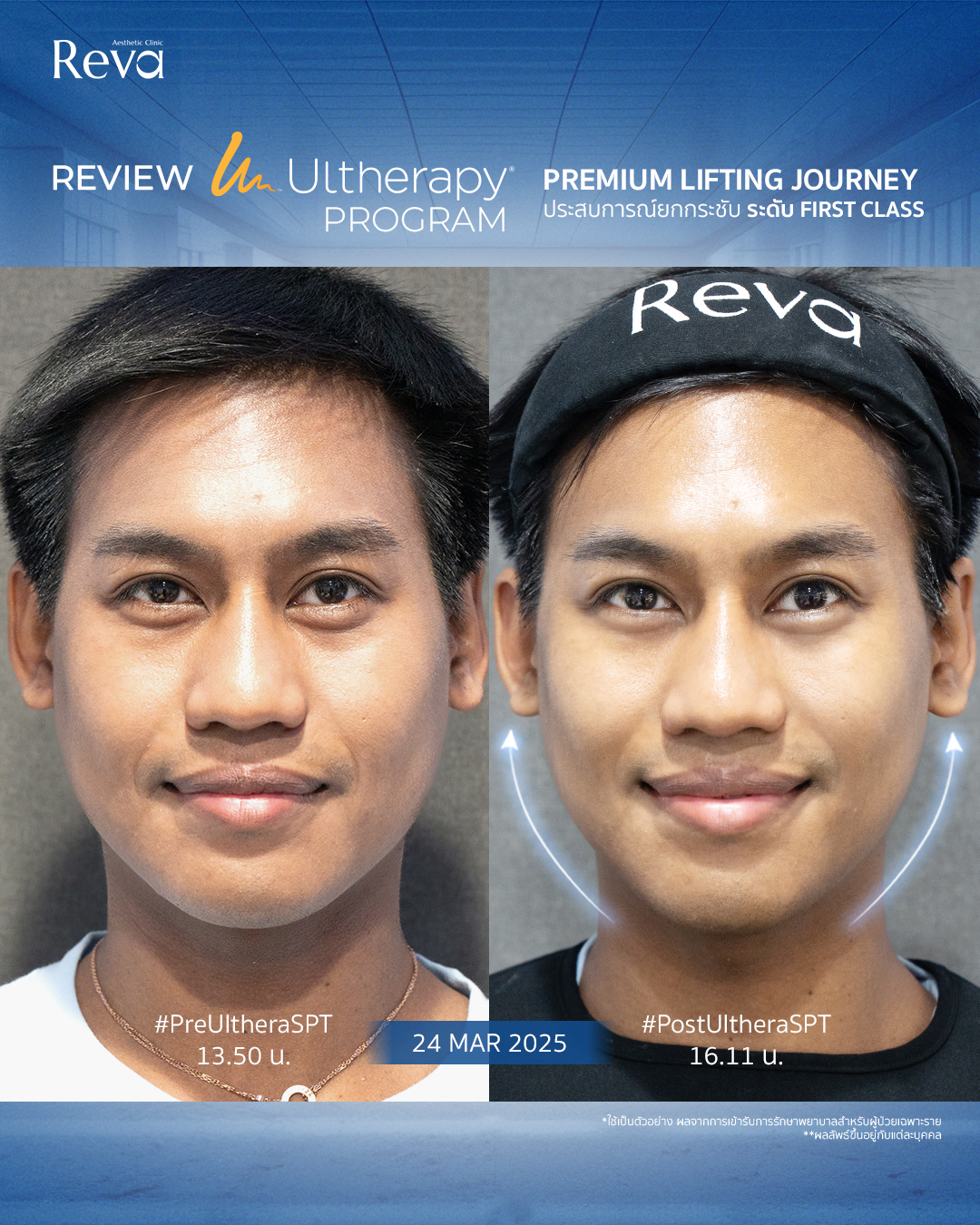 ผลลัพธ์ Ulthera