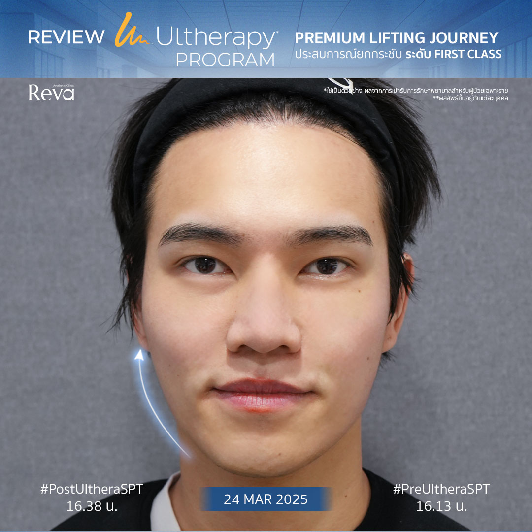 ผลลัพธ์ Ulthera