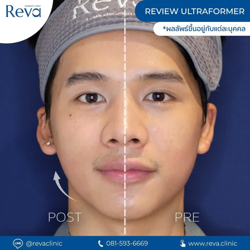 ผลลัพธ์ Ultraformer III